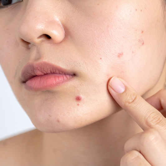 Acné hormonale : comprendre ton cycle pour mieux gérer tes boutons